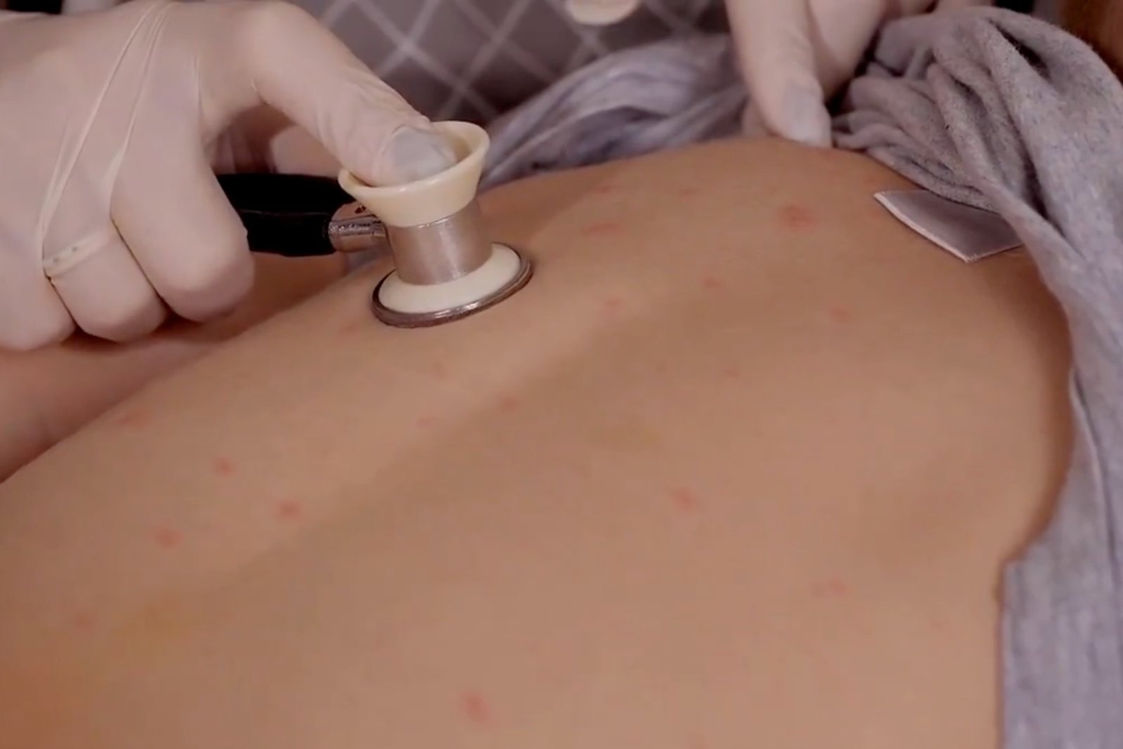 Suben a 31 las muertes por sarampión, ¿dónde ocurrieron los últimos decesos?